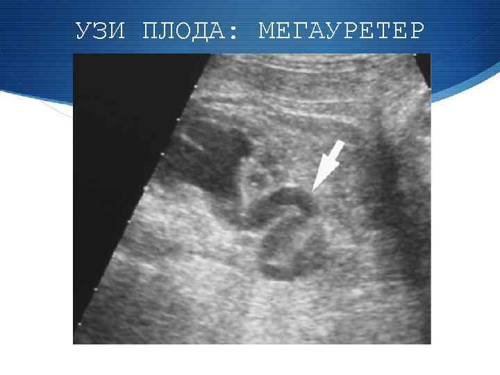 УЗИ ПЛОДА: МЕГАУРЕТЕР 