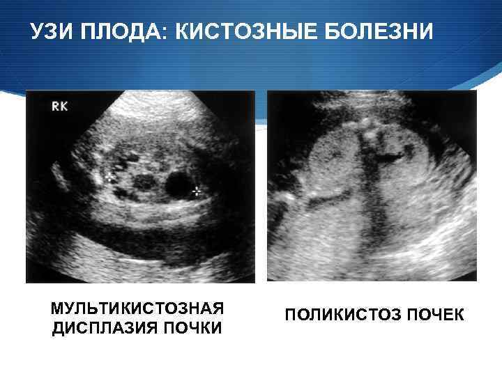 Поликистоз инфильтративного типа мелкокистозного типа дает эхографическую картину