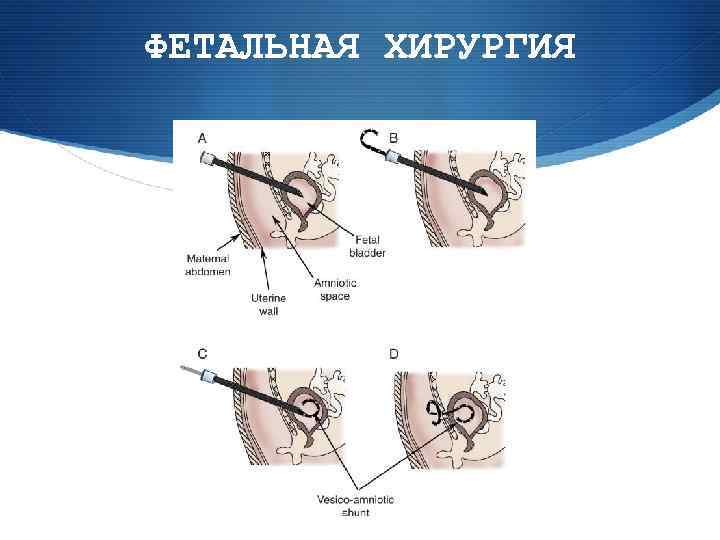 ФЕТАЛЬНАЯ ХИРУРГИЯ 