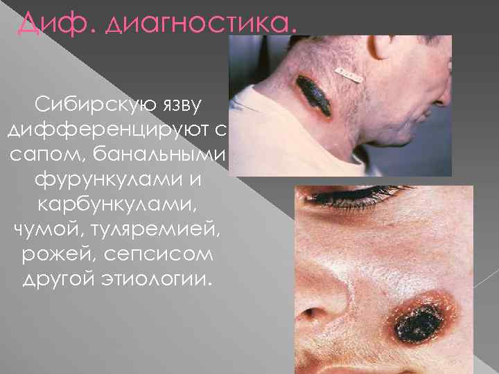 Диф. диагностика. Сибирскую язву дифференцируют с сапом, банальными фурункулами и карбункулами, чумой, туляремией, рожей,