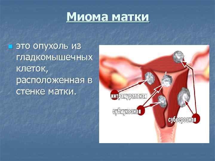 Миома матки n это опухоль из гладкомышечных клеток, расположенная в стенке матки. 