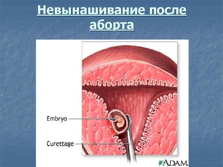 Невынашивание после аборта 