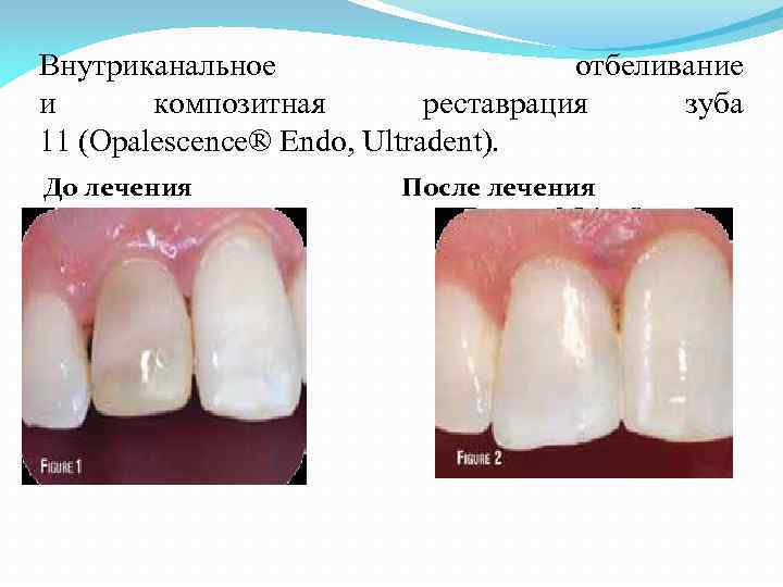 Внутриканальное отбеливание и композитная реставрация зуба 11 (Opalescence® Endo, Ultradent). До лечения После лечения