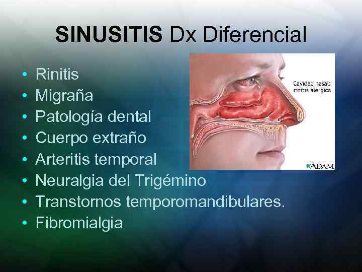 SINUSITIS Dx Diferencial • • Rinitis Migraña Patología dental Cuerpo extraño Arteritis temporal Neuralgia