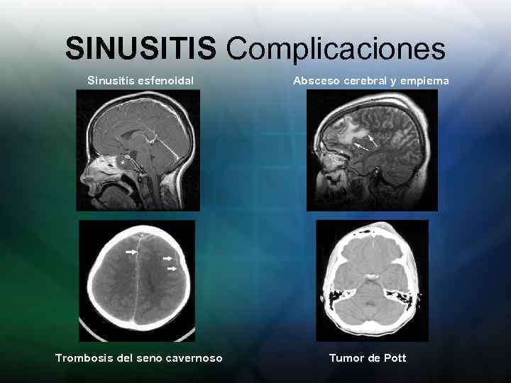 SINUSITIS Complicaciones Sinusitis esfenoidal Trombosis del seno cavernoso Absceso cerebral y empiema Tumor de