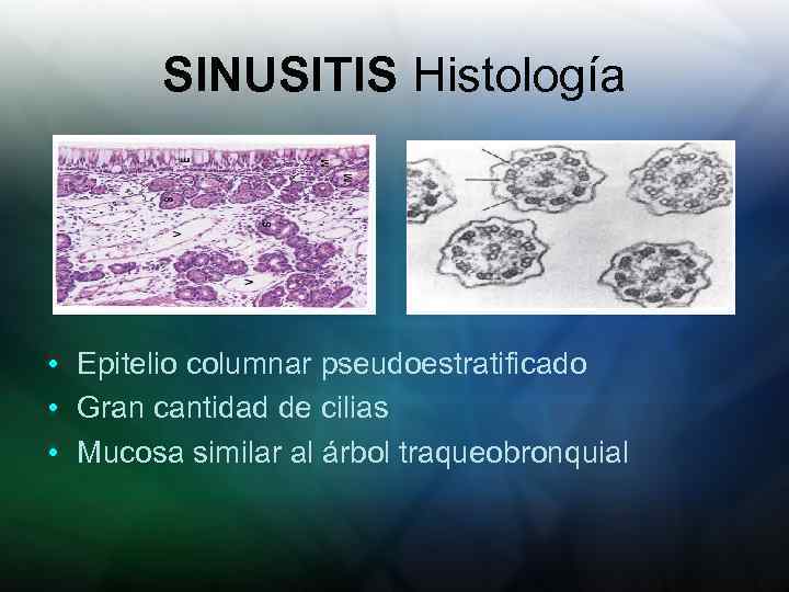 SINUSITIS Histología • Epitelio columnar pseudoestratificado • Gran cantidad de cilias • Mucosa similar