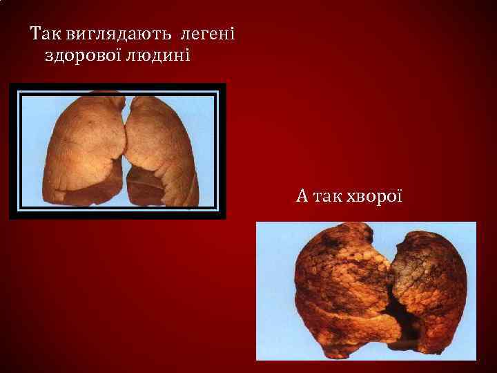 Так виглядають легені здорової людині А так хворої 
