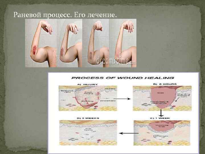 Раневой процесс. Его лечение. 