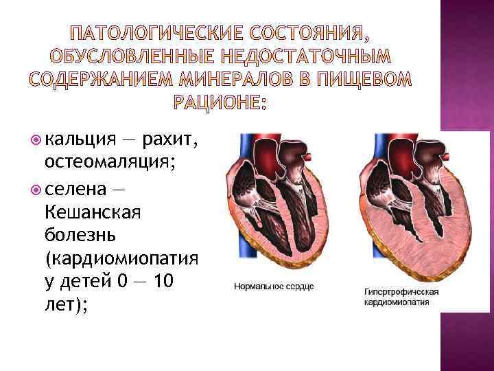 Презентация на тему кардиомиопатии