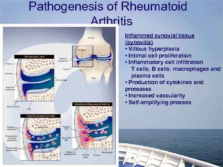 Pathogenesis of Rheumatoid Arthritis Inflammed synovial tissue (synovitis) • Villous hyperplasia • Intimal cell