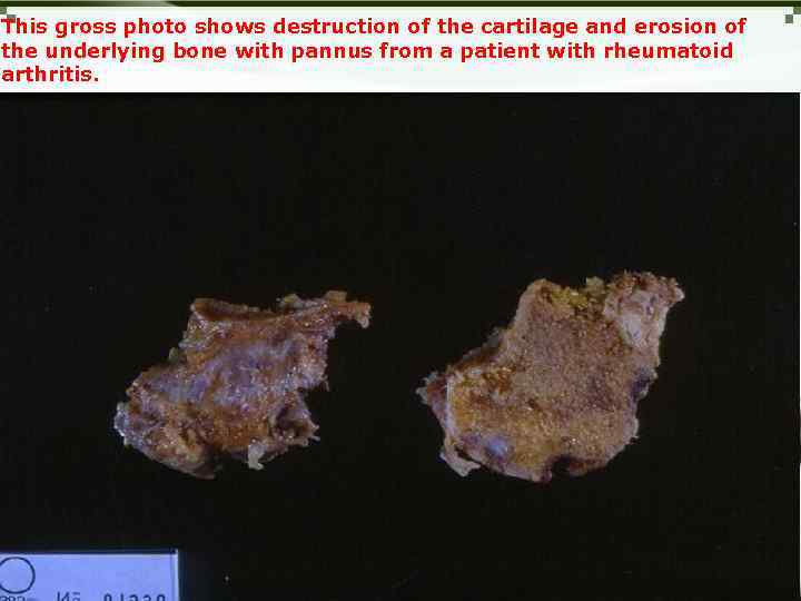 This gross photo shows destruction of the cartilage and erosion of the underlying bone