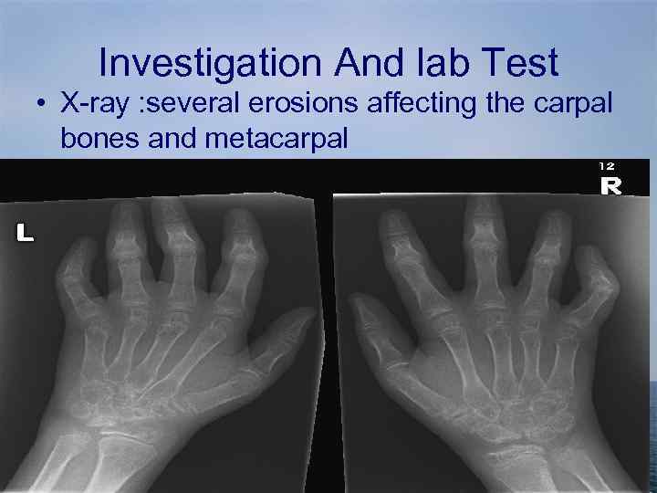 Investigation And lab Test • X-ray : several erosions affecting the carpal bones and