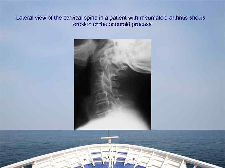 Lateral view of the cervical spine in a patient with rheumatoid arthritis shows erosion
