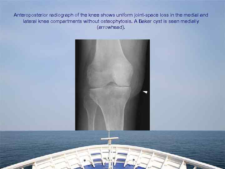 Anteroposterior radiograph of the knee shows uniform joint-space loss in the medial and lateral
