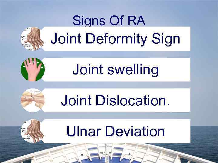 Signs Of RA Joint Deformity Sign Joint swelling Joint Dislocation. Ulnar Deviation 