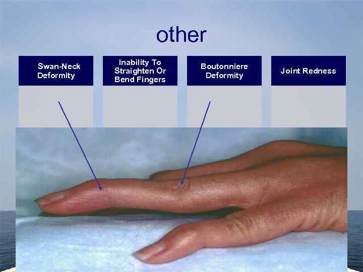 other Swan-Neck Deformity Inability To Straighten Or Bend Fingers Boutonniere Deformity Joint Redness 