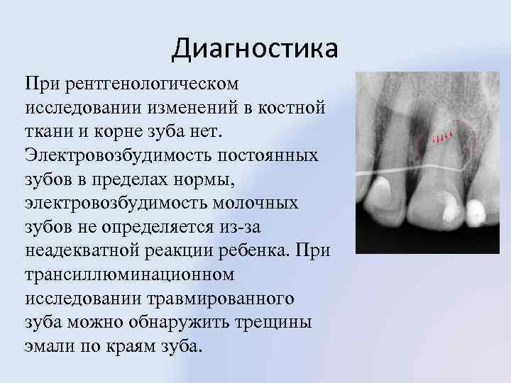 Диагностика При рентгенологическом исследовании изменений в костной ткани и корне зуба нет. Электровозбудимость постоянных