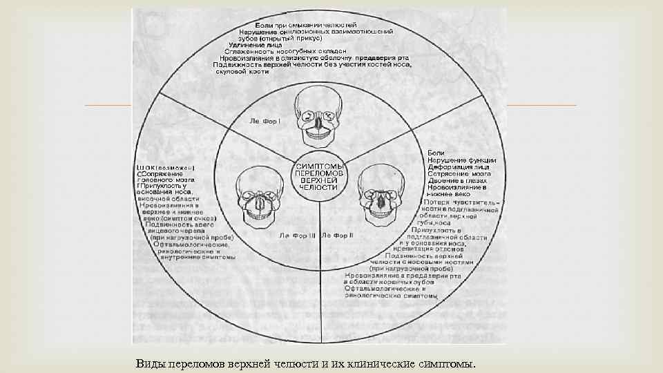  Виды переломов верхней челюсти и их клинические симптомы. 