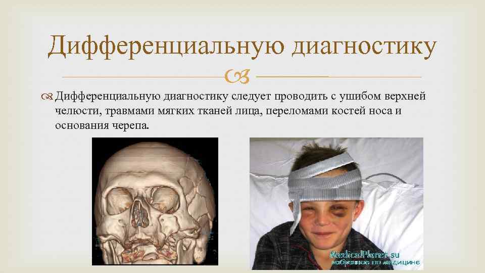 Дифференциальную диагностику следует проводить с ушибом верхней челюсти, травмами мягких тканей лица, переломами костей