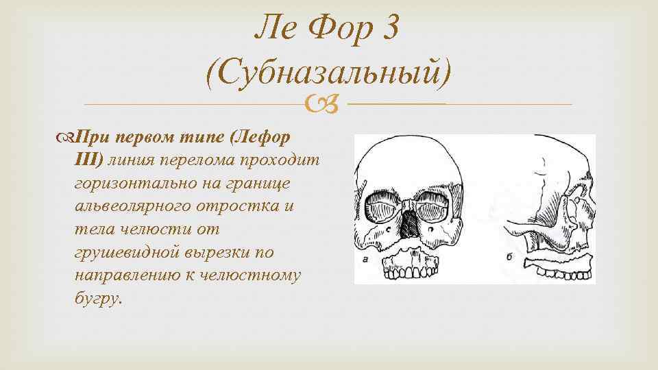 Ле Фор 3 (Субназальный) При первом типе (Лефор III) линия перелома проходит горизонтально на