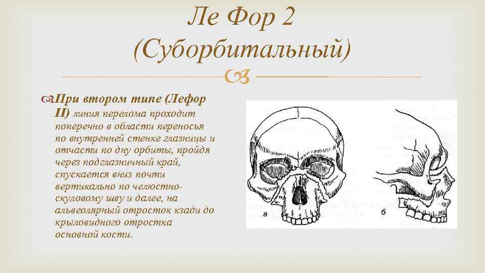 Ле Фор 2 (Суборбитальный) При втором типе (Лефор II) линия перелома проходит поперечно в