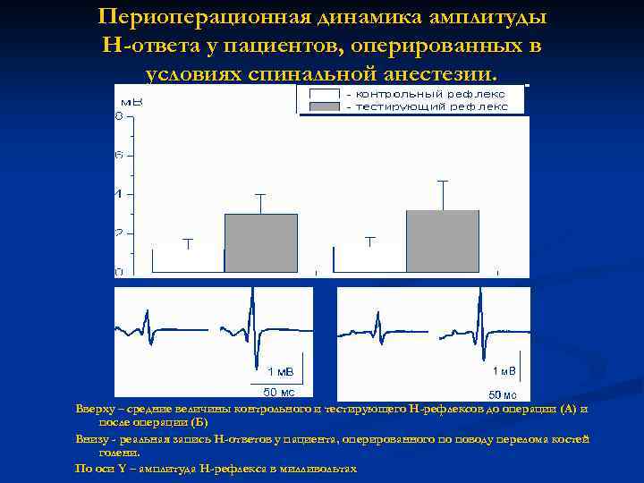 Периоперационная динамика амплитуды Н-ответа у пациентов, оперированных в условиях спинальной анестезии. Вверху – средние