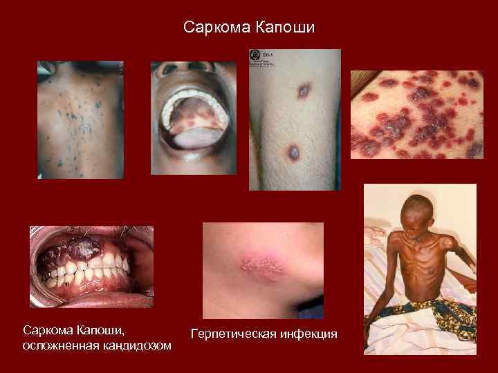 Саркома Капоши, осложненная кандидозом Герпетическая инфекция 