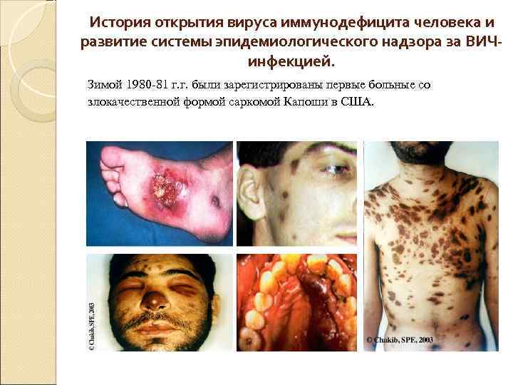 История открытия вируса иммунодефицита человека и развитие системы эпидемиологического надзора за ВИЧинфекцией. Зимой 1980