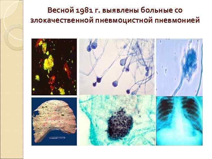 Весной 1981 г. выявлены больные со злокачественной пневмоцистной пневмонией. 