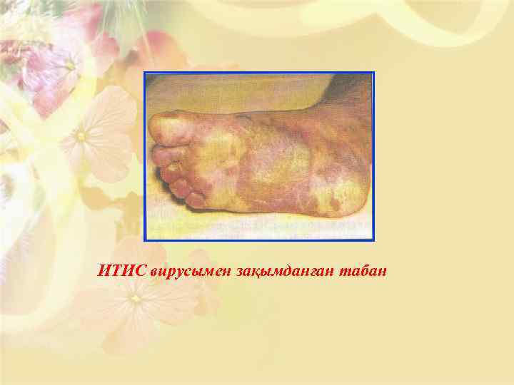 ИТИС вирусымен зақымданған табан 