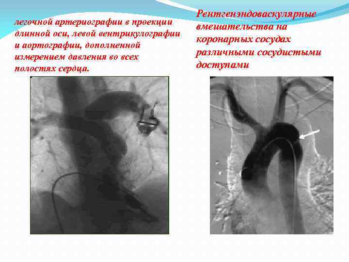 легочной артериографии в проекции длинной оси, левой вентрикулографии и аортографии, дополненной измерением давления во