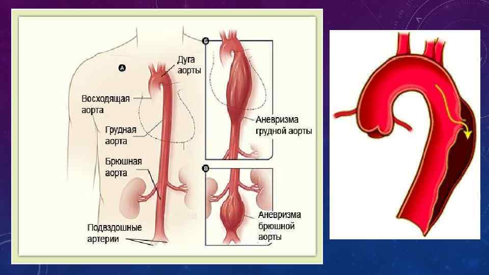 Стенки аорты