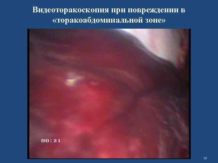 Видеоторакоскопия при повреждении в «торакоабдоминальной зоне» 39 