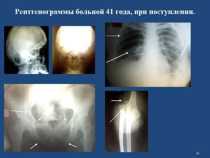Рентгенограммы больной 41 года, при поступлении. 43 