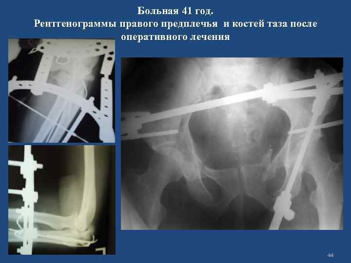 Больная 41 год. Рентгенограммы правого предплечья и костей таза после оперативного лечения 44 