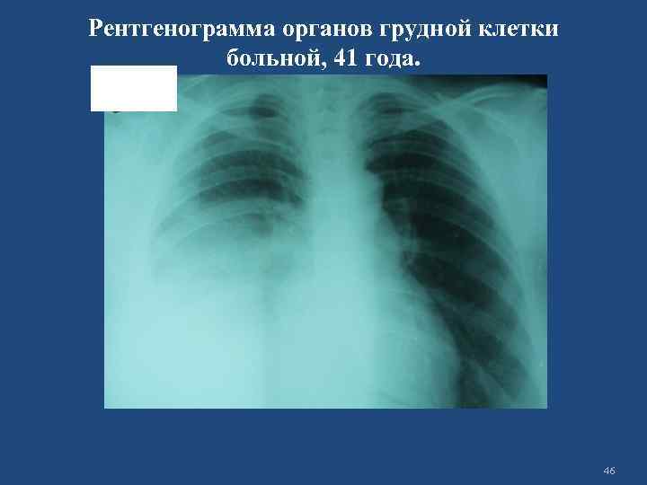 Рентгенограмма органов грудной клетки больной, 41 года. 46 