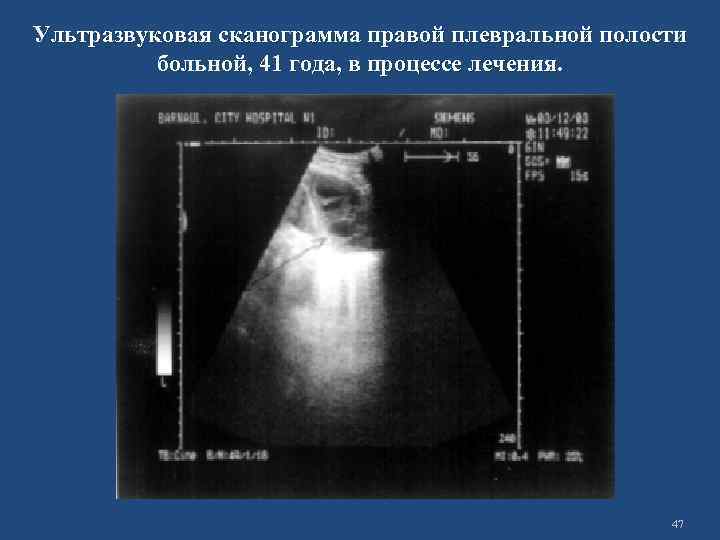 Ультразвуковая сканограмма правой плевральной полости больной, 41 года, в процессе лечения. 47 