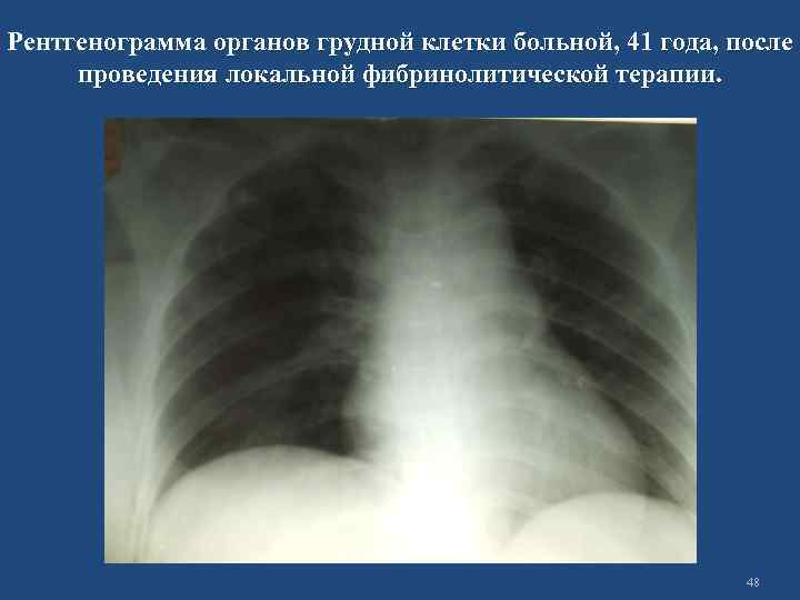 Рентгенограмма органов грудной клетки больной, 41 года, после проведения локальной фибринолитической терапии. 48 