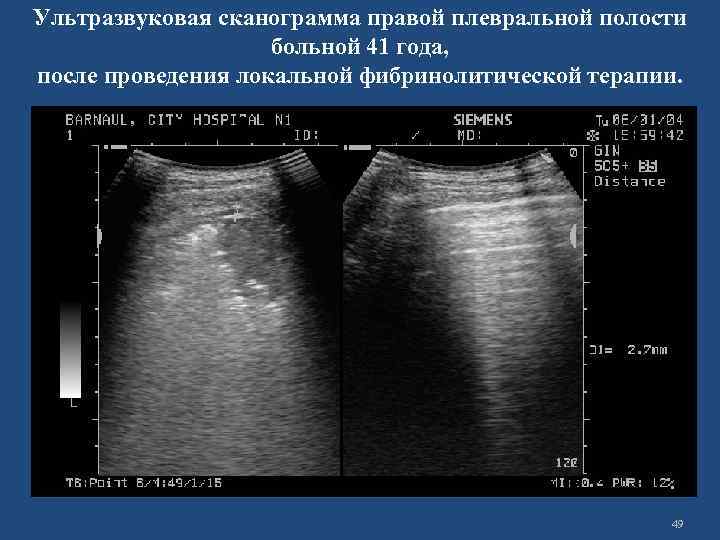 Ультразвуковая сканограмма правой плевральной полости больной 41 года, после проведения локальной фибринолитической терапии. 49