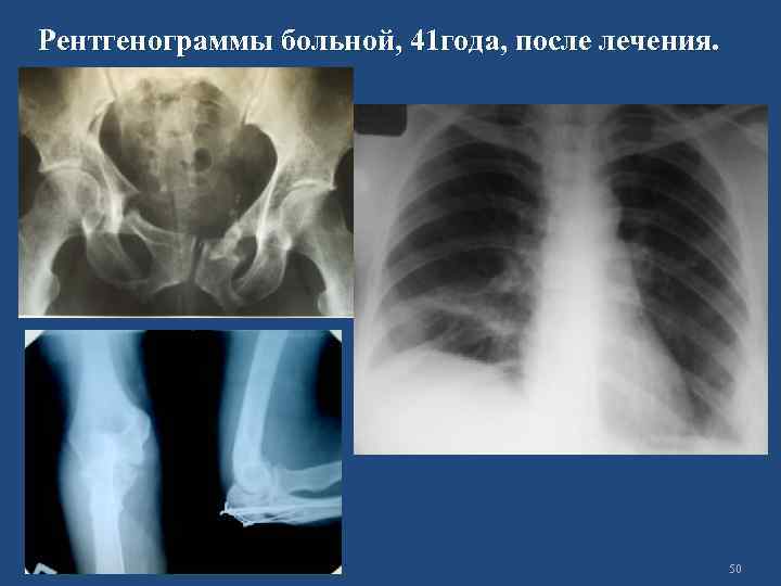 Рентгенограммы больной, 41 года, после лечения. 50 