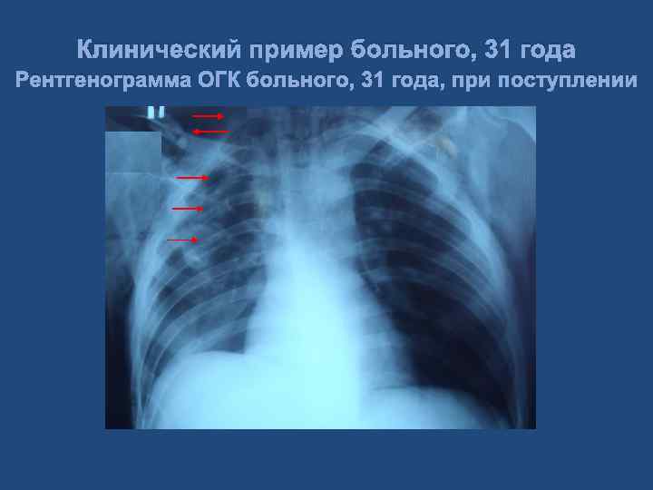 Клинический пример больного, 31 года Рентгенограмма ОГК больного, 31 года, при поступлении 