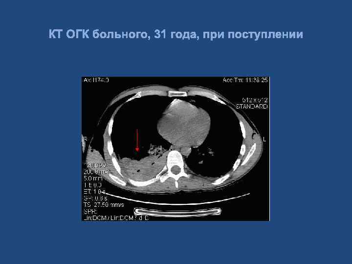 КТ ОГК больного, 31 года, при поступлении 