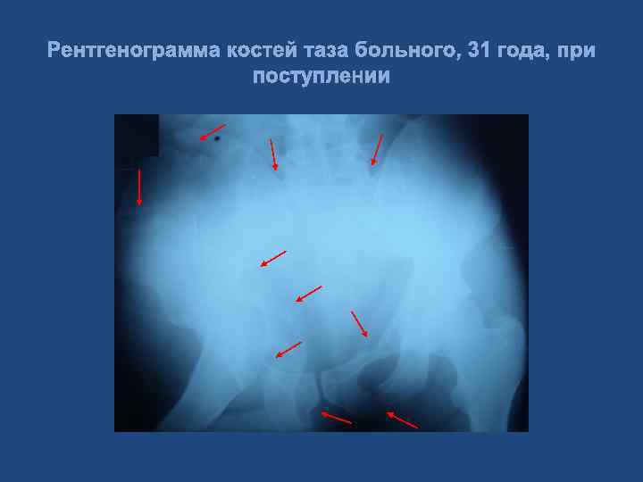 Рентгенограмма костей таза больного, 31 года, при поступлении 