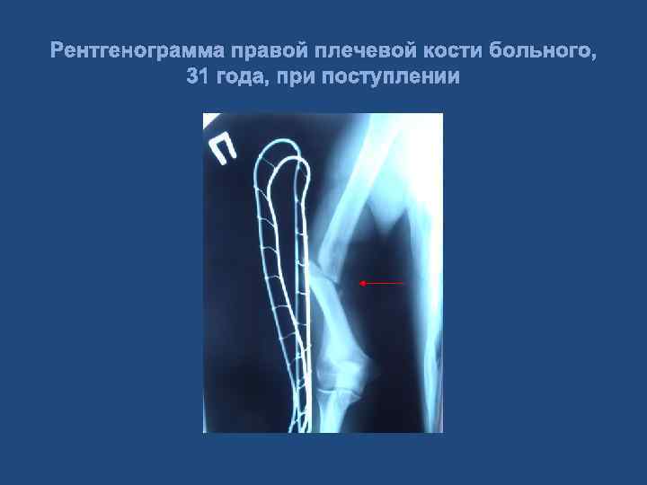 Рентгенограмма правой плечевой кости больного, 31 года, при поступлении 