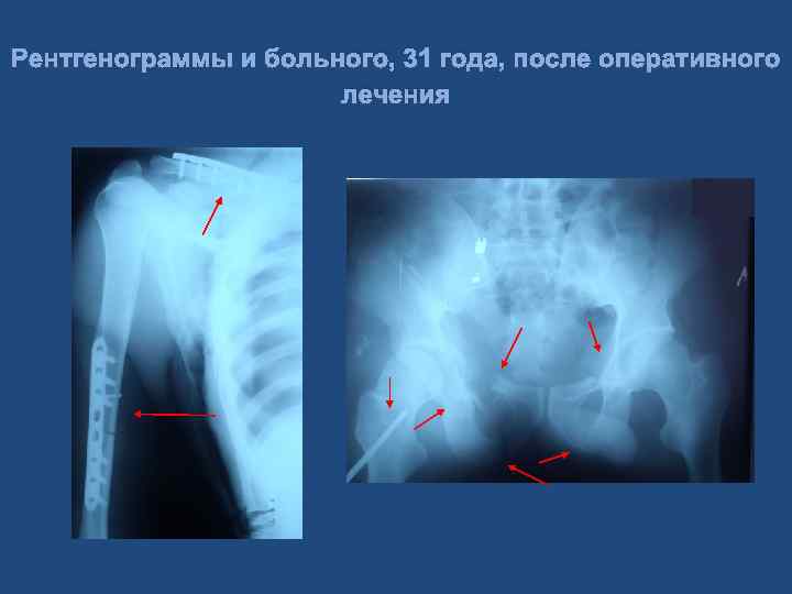Рентгенограммы и больного, 31 года, после оперативного лечения 
