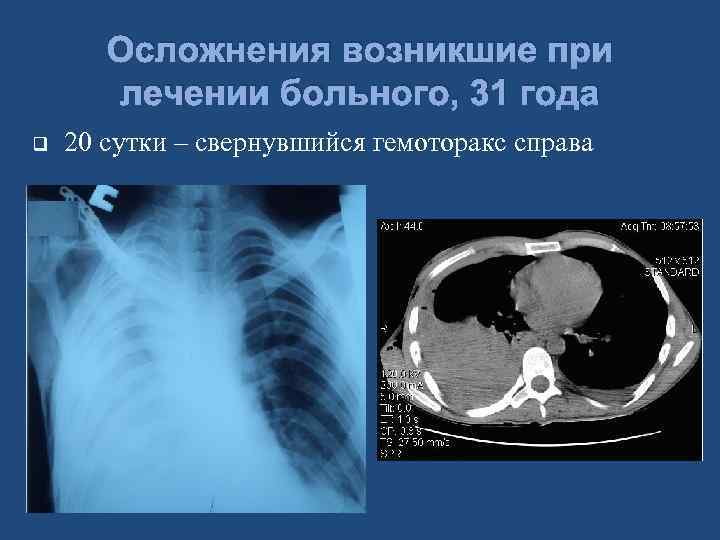 Осложнения возникшие при лечении больного, 31 года q 20 сутки – свернувшийся гемоторакс справа