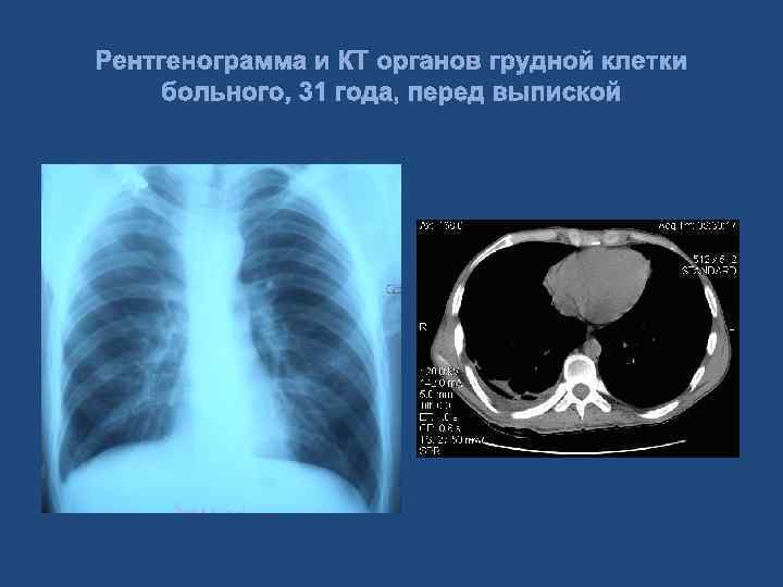 Рентгенограмма и КТ органов грудной клетки больного, 31 года, перед выпиской 