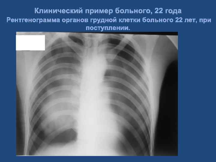 Клинический пример больного, 22 года Рентгенограмма органов грудной клетки больного 22 лет, при поступлении.