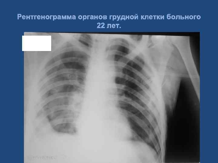Рентгенограмма органов грудной клетки больного 22 лет. 