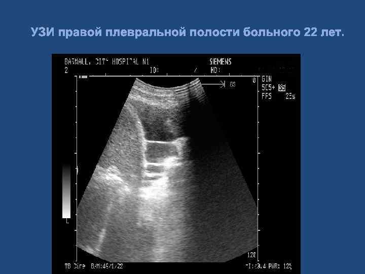 Узи плевральной полости. УЗИ плевральных полостей методика. УЗИ плевральных синусов. Свободная жидкость в плевральной полости на УЗИ. УЗИ плевральных полостей плеврит.